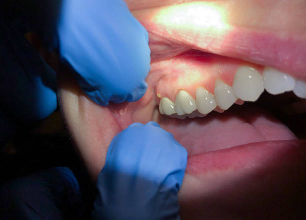 Best Emergency Dental Care for Broken or Chipped Teeth in Inola, OK